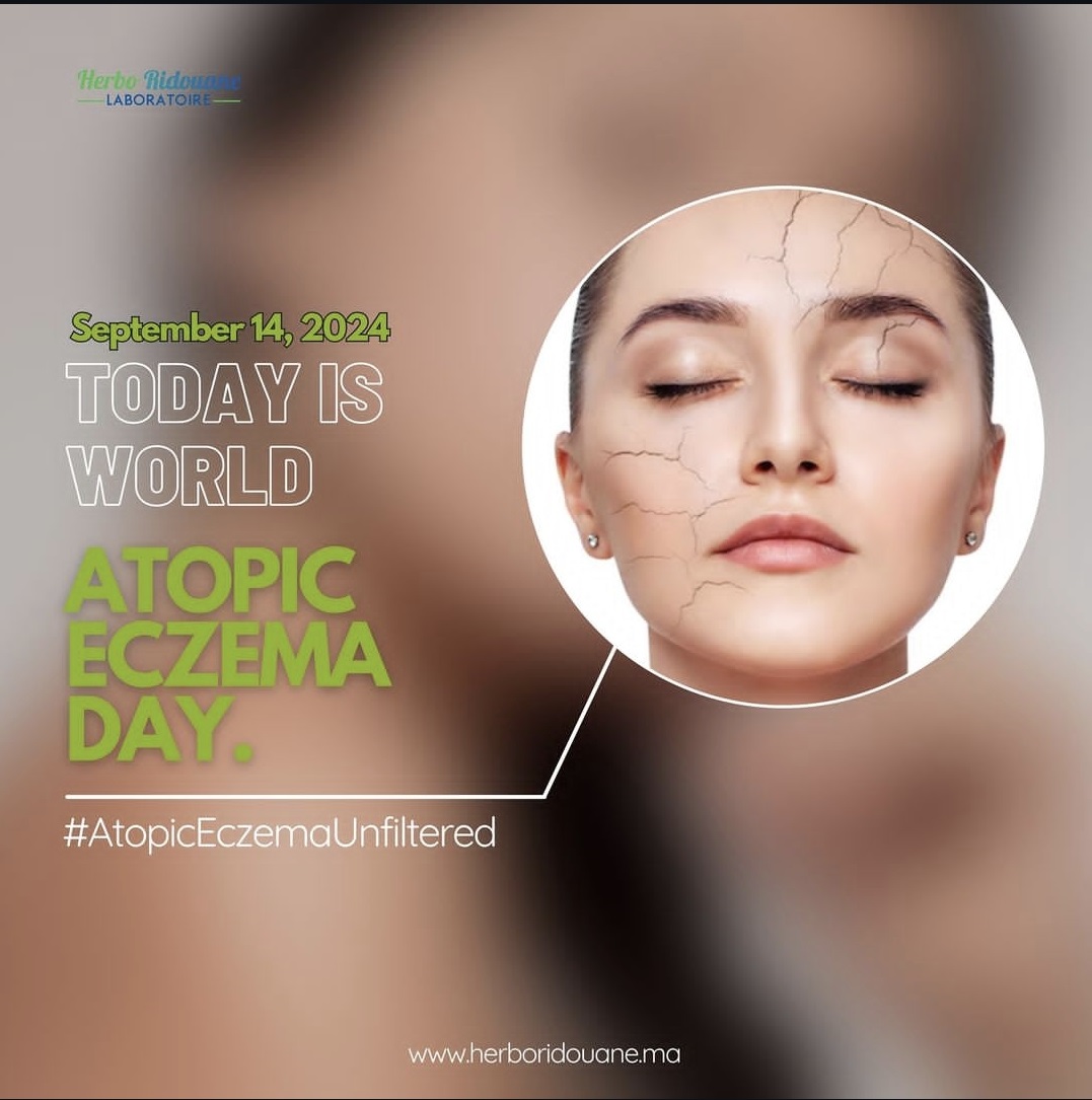 atopic eczema day